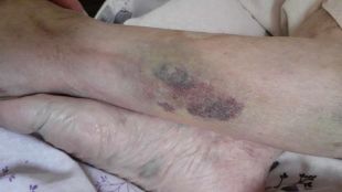Насилие над 104-годишна баба във Видинската болница